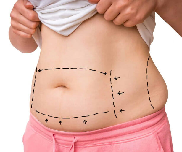 abdominoplastie
