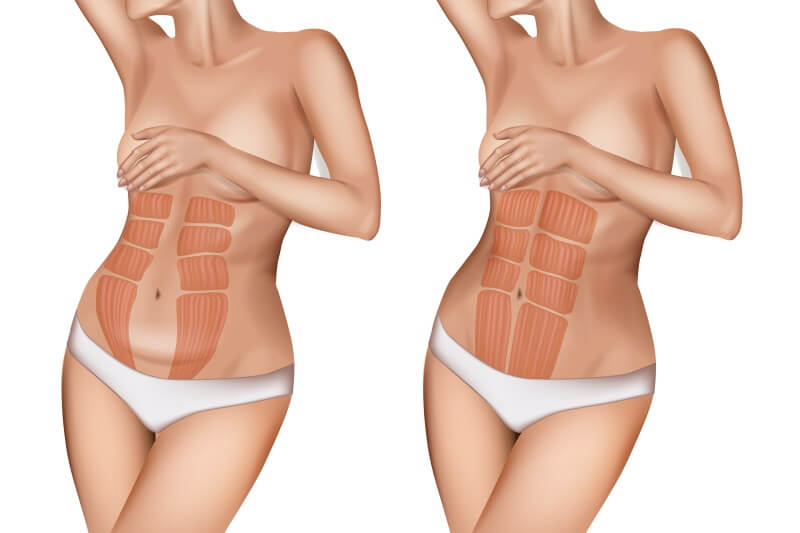 diastasis operation