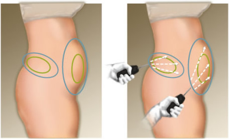 Liposuccion laser en Tunisie